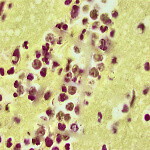 Naegleria fowleri